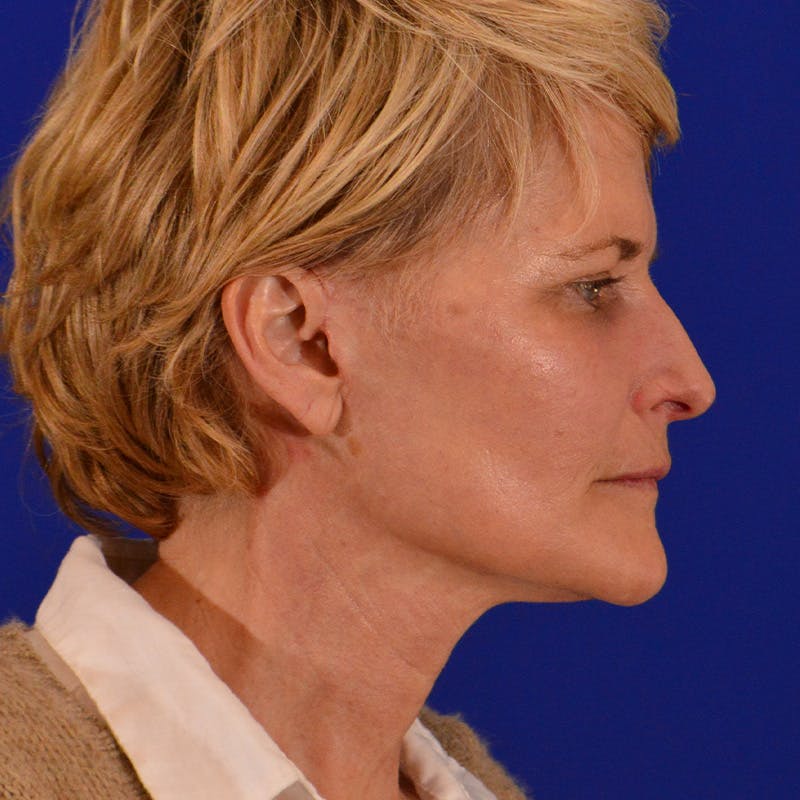 Co2 Laser Resurfacing Before & After Gallery - Patient 380986 - Image 6
