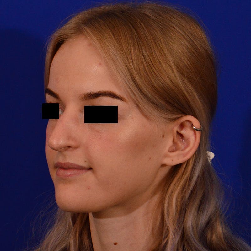 Female Rhinoplasty Before & After Gallery - Patient 124593 - Image 9