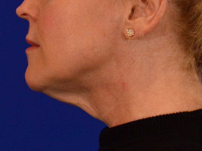 Facelift & Necklift Before & After Gallery - Patient 654569 - Image 9