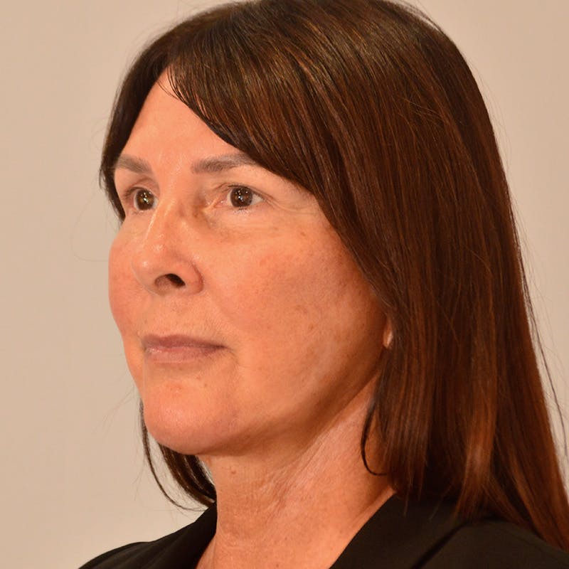 Facelift & Necklift Before & After Gallery - Patient 246000 - Image 10