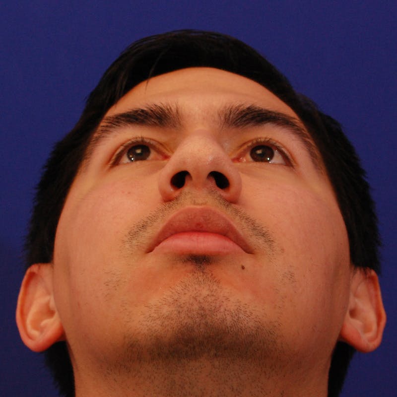 Chin Augmentation Before & After Gallery - Patient 332242 - Image 11
