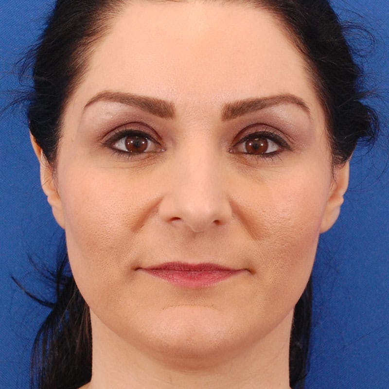 Long Nose Before & After Gallery - Patient 529509 - Image 1