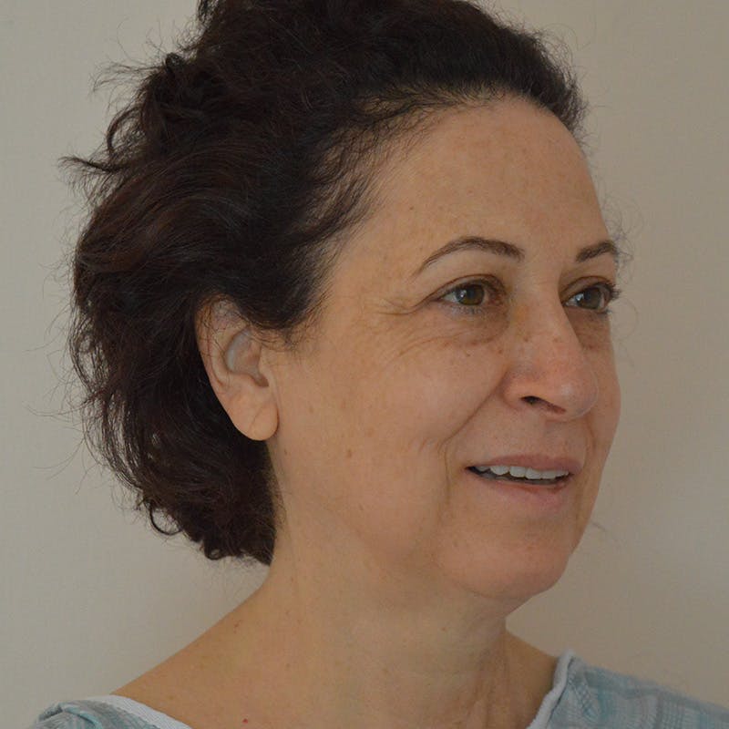 Facelift & Necklift Before & After Gallery - Patient 217555 - Image 3