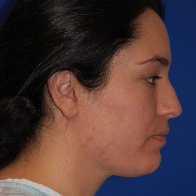Dorsal Hump Before & After Gallery - Patient 319034 - Image 1