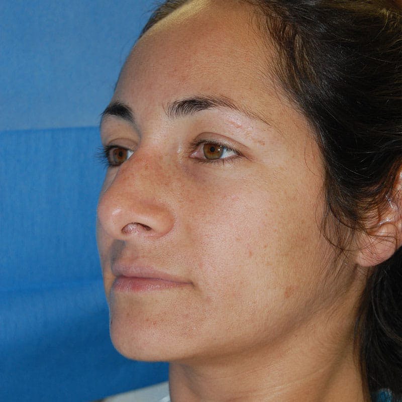 Wide Nose Before & After Gallery - Patient 173051 - Image 3