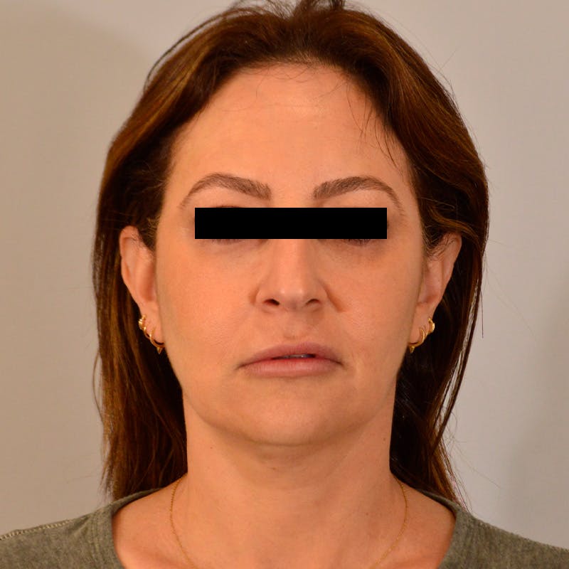 Facelift & Necklift Before & After Gallery - Patient 302569 - Image 1