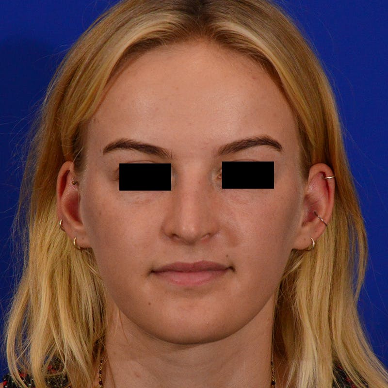 Female Rhinoplasty Before & After Gallery - Patient 124593 - Image 4