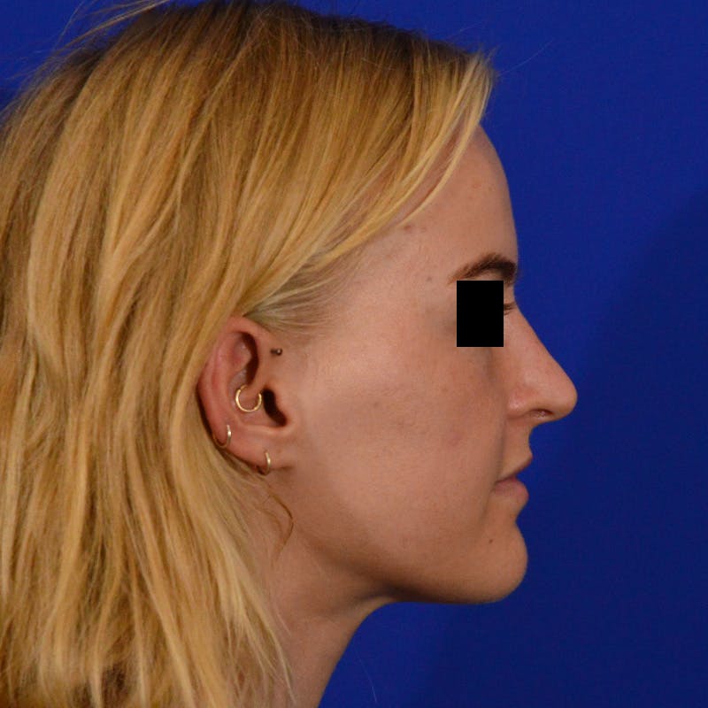 Female Rhinoplasty Before & After Gallery - Patient 124593 - Image 8