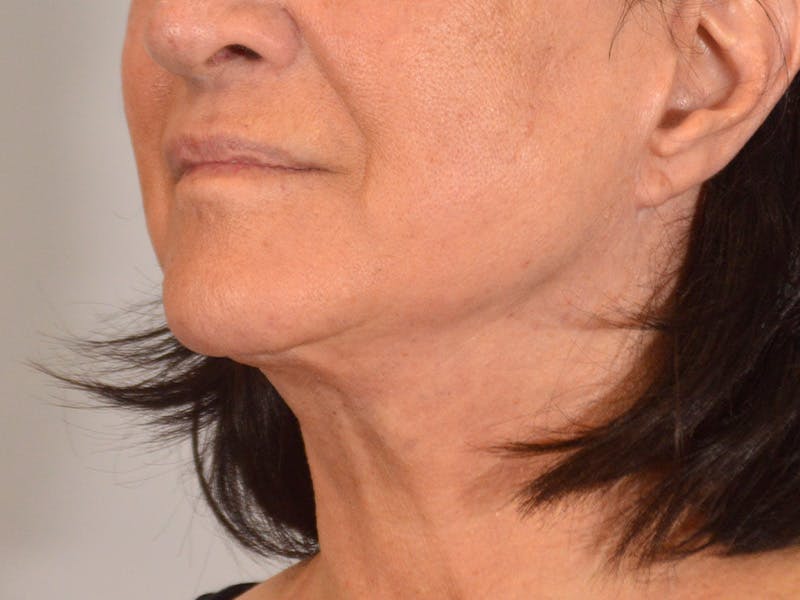 Facelift & Necklift Before & After Gallery - Patient 162323 - Image 8