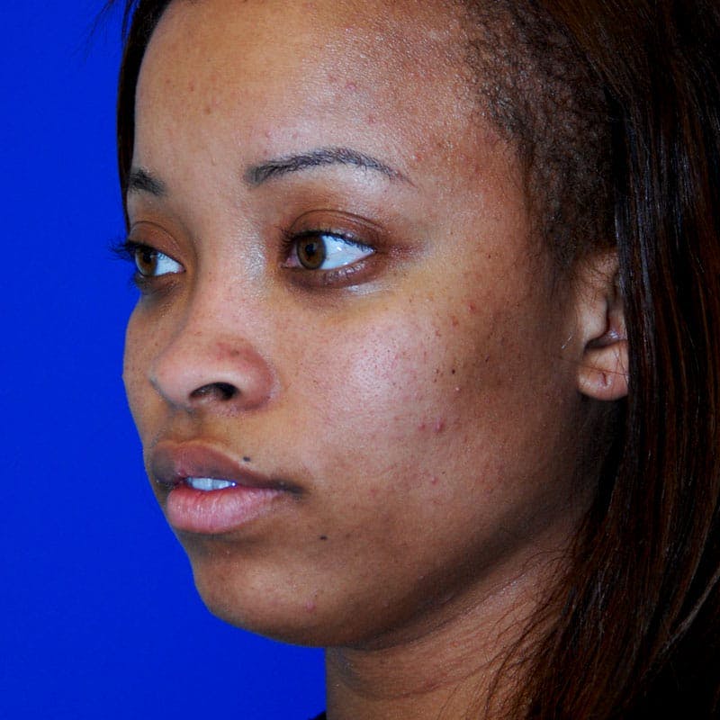 Wide Nose Before & After Gallery - Patient 155718 - Image 3