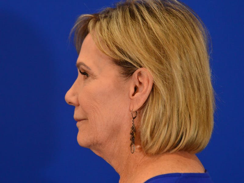 Facelift & Necklift Before & After Gallery - Patient 536616 - Image 7