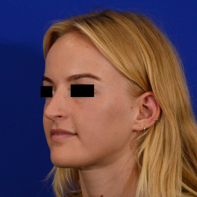 Female Rhinoplasty Before & After Gallery - Patient 124593 - Image 10
