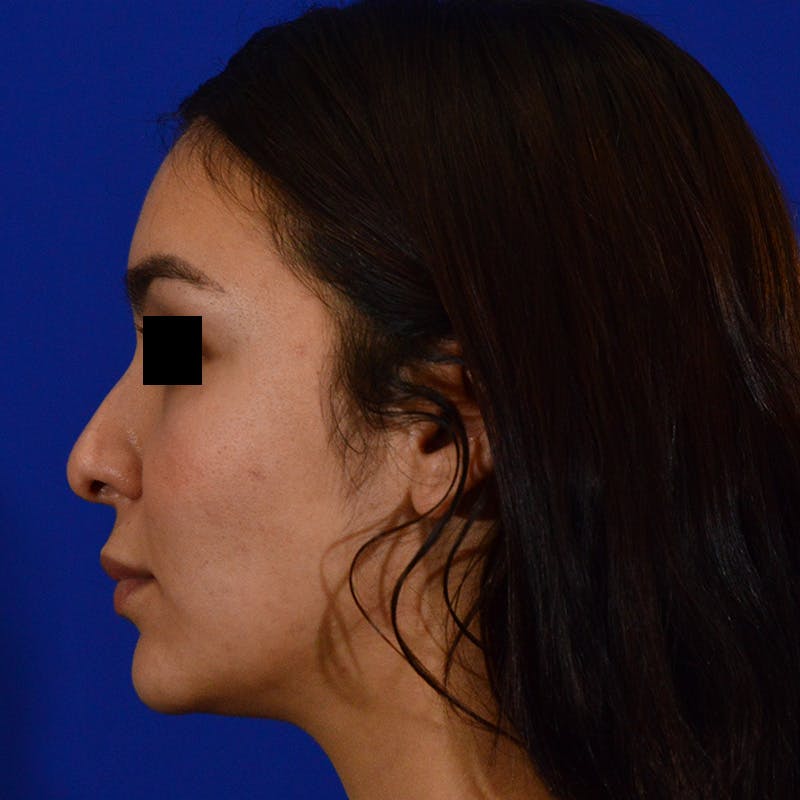 Female Rhinoplasty Before & After Gallery - Patient 143317 - Image 1