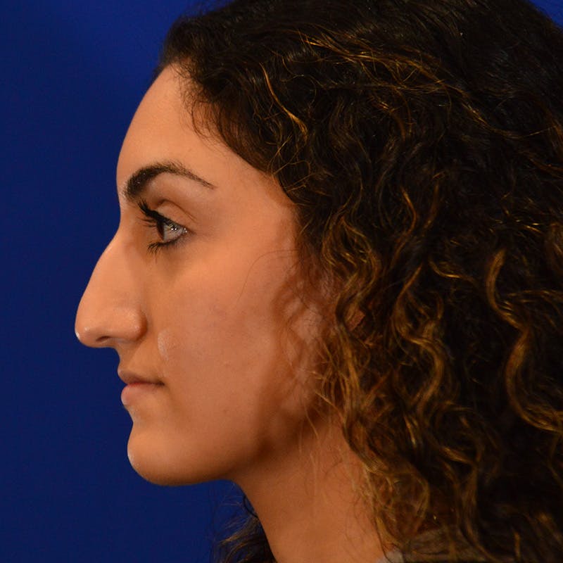 Female Rhinoplasty Before & After Gallery - Patient 224146 - Image 1