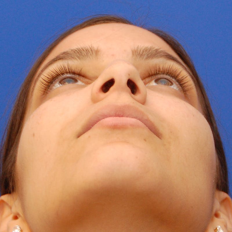 Female Rhinoplasty Before & After Gallery - Patient 396658 - Image 11