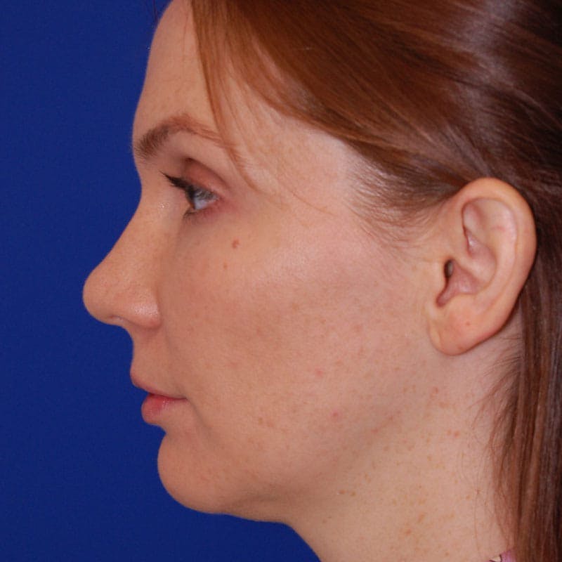 Crooked Nose Before & After Gallery - Patient 803322 - Image 6