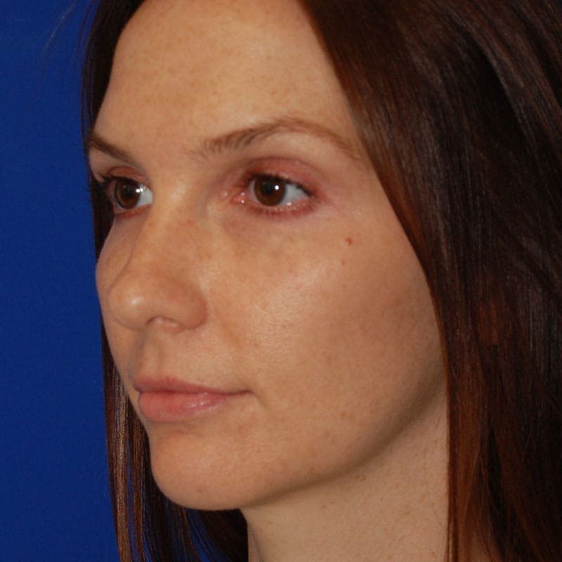 Crooked Nose Before & After Gallery - Patient 803322 - Image 3