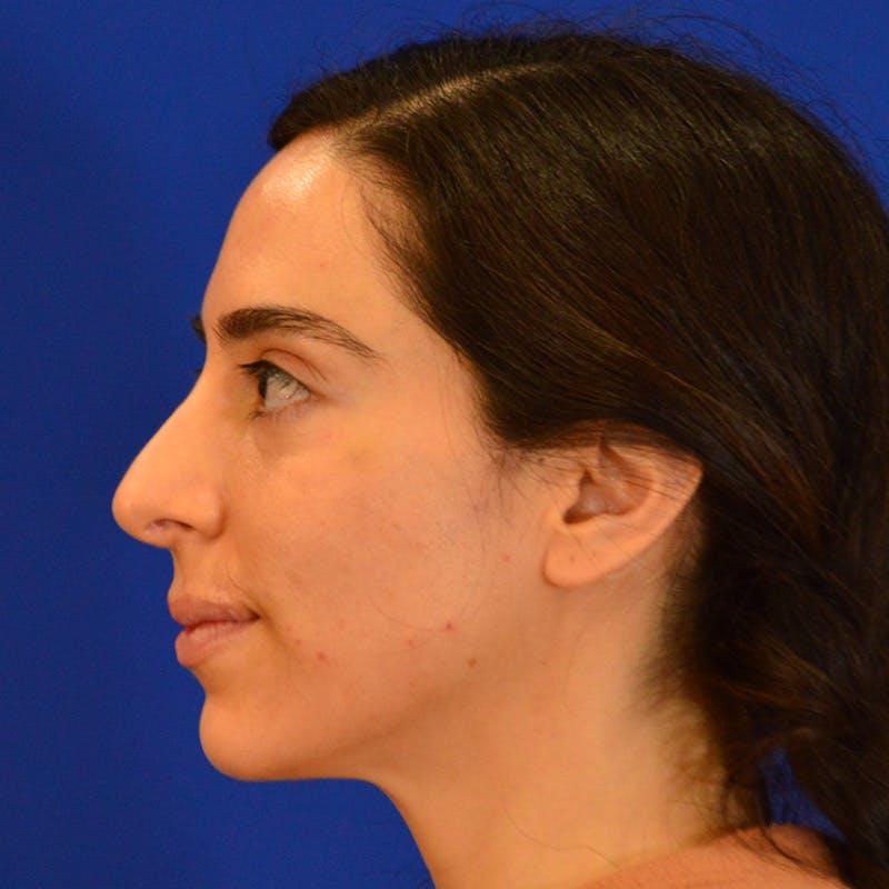 Facial Fat Grafting Before & After Gallery - Patient 411676 - Image 3