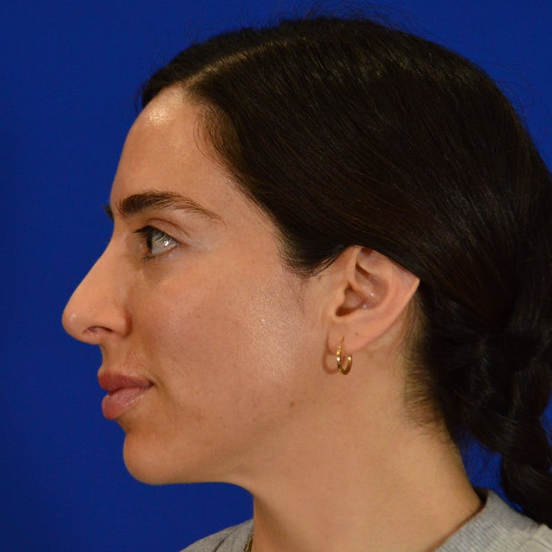 Facial Fat Grafting Before & After Gallery - Patient 411676 - Image 4