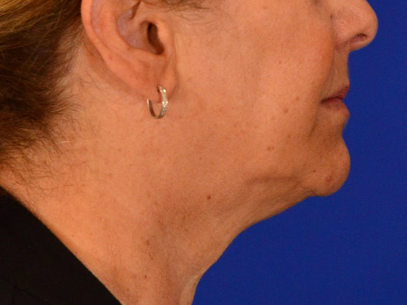 Facelift & Necklift Before & After Gallery - Patient 391454 - Image 5