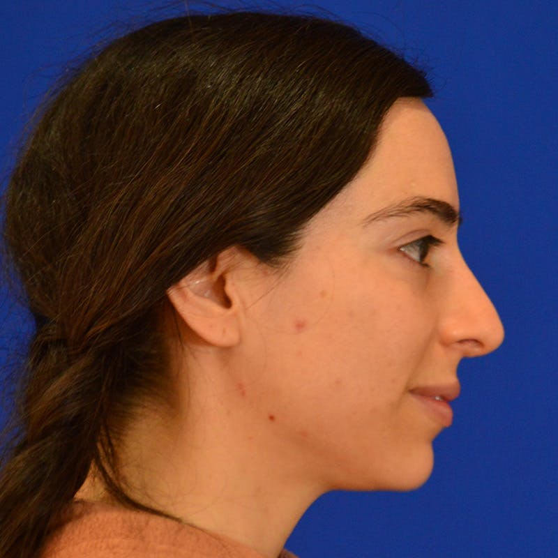 Facial Fat Grafting Before & After Gallery - Patient 411676 - Image 5