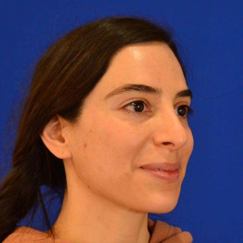 Facial Fat Grafting Before & After Gallery - Patient 411676 - Image 9