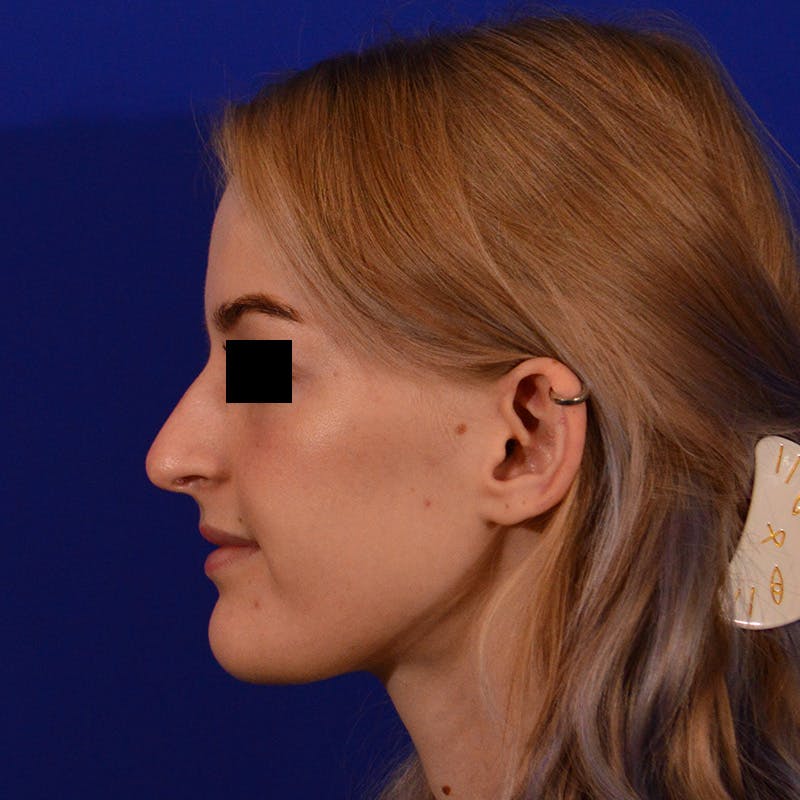 Female Rhinoplasty Before & After Gallery - Patient 124593 - Image 1