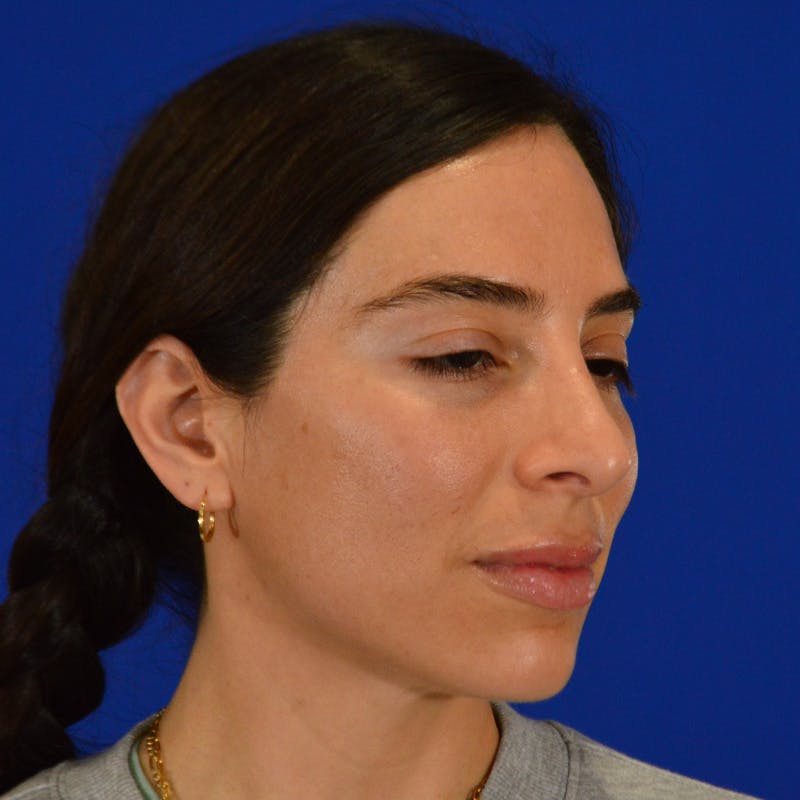Facial Fat Grafting Before & After Gallery - Patient 411676 - Image 10