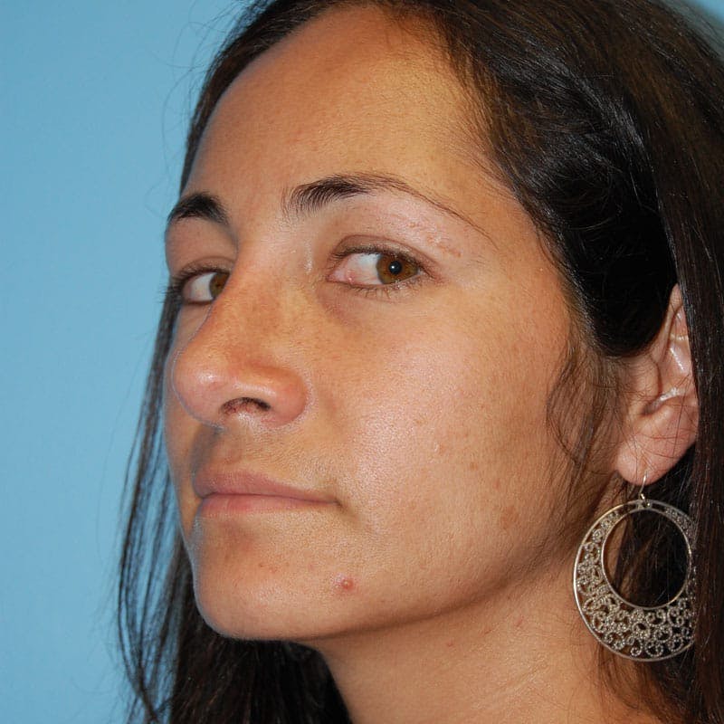 Wide Nose Before & After Gallery - Patient 173051 - Image 4