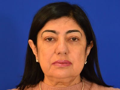 Facelift & Necklift Before & After Gallery - Patient 201698 - Image 1