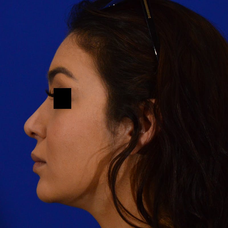 Female Rhinoplasty Before & After Gallery - Patient 143317 - Image 2
