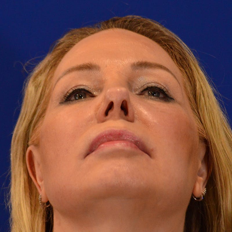 Revision Rhinoplasty Before & After Gallery - Patient 156468 - Image 11