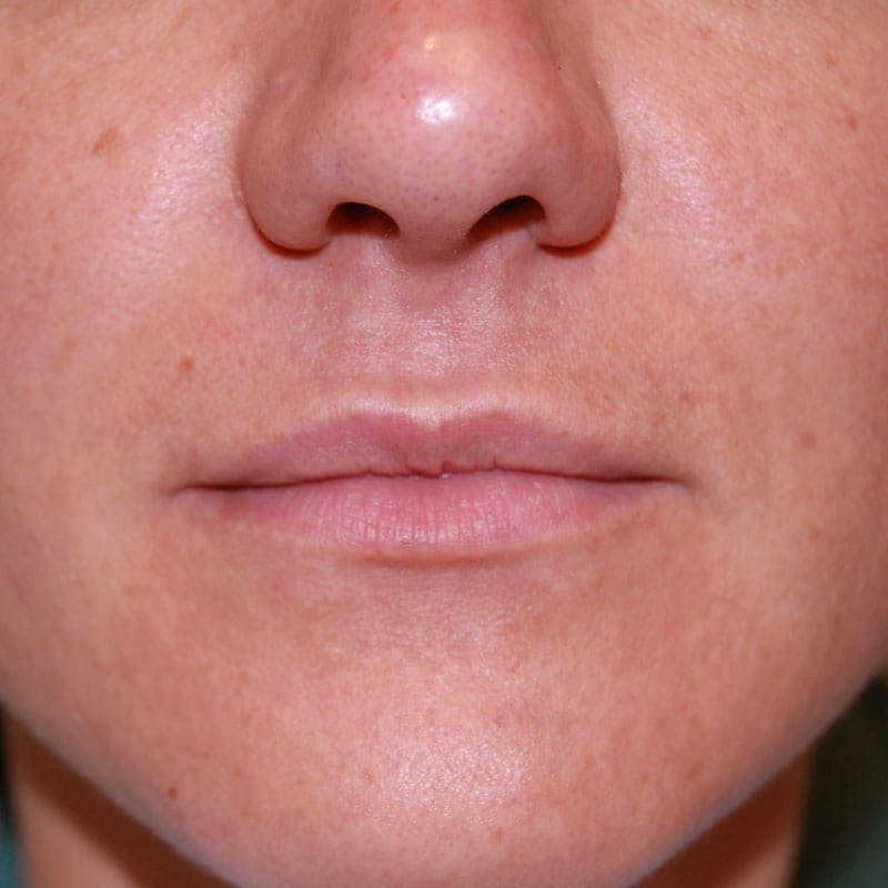 Lip Filler Before & After Gallery - Patient 317981 - Image 1
