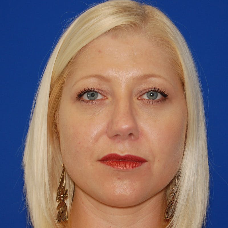 Upper Eyelid Surgery Before & After Gallery - Patient 183887 - Image 1