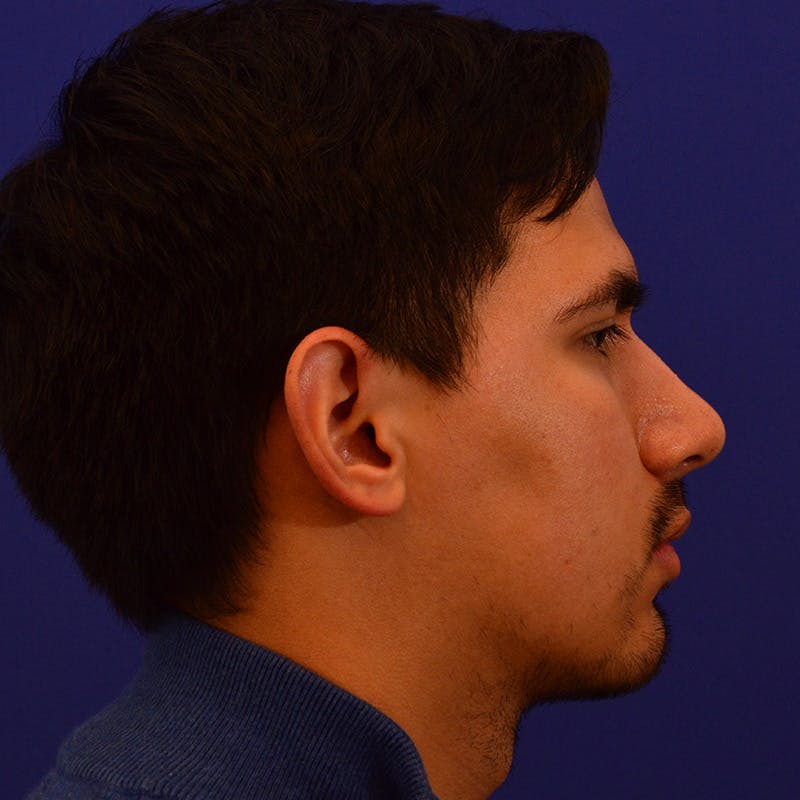 Chin Augmentation Before & After Gallery - Patient 332242 - Image 4