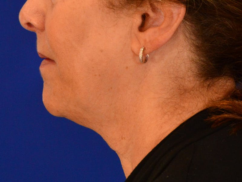 Facelift & Necklift Before & After Gallery - Patient 391454 - Image 3