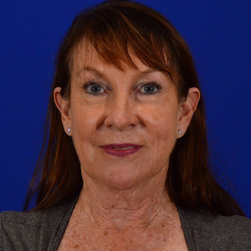 Co2 Laser Resurfacing Before & After Gallery - Patient 374474 - Image 1