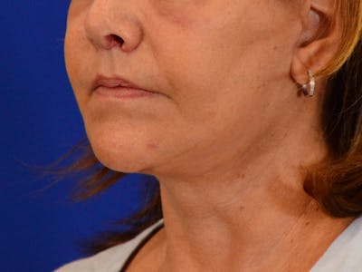Facelift & Necklift Before & After Gallery - Patient 391454 - Image 2