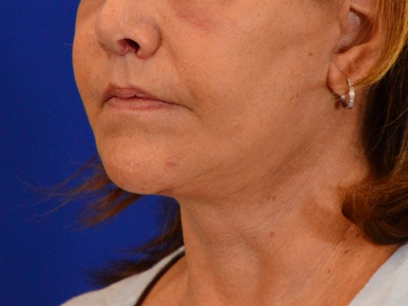 Facelift & Necklift Before & After Gallery - Patient 391454 - Image 2