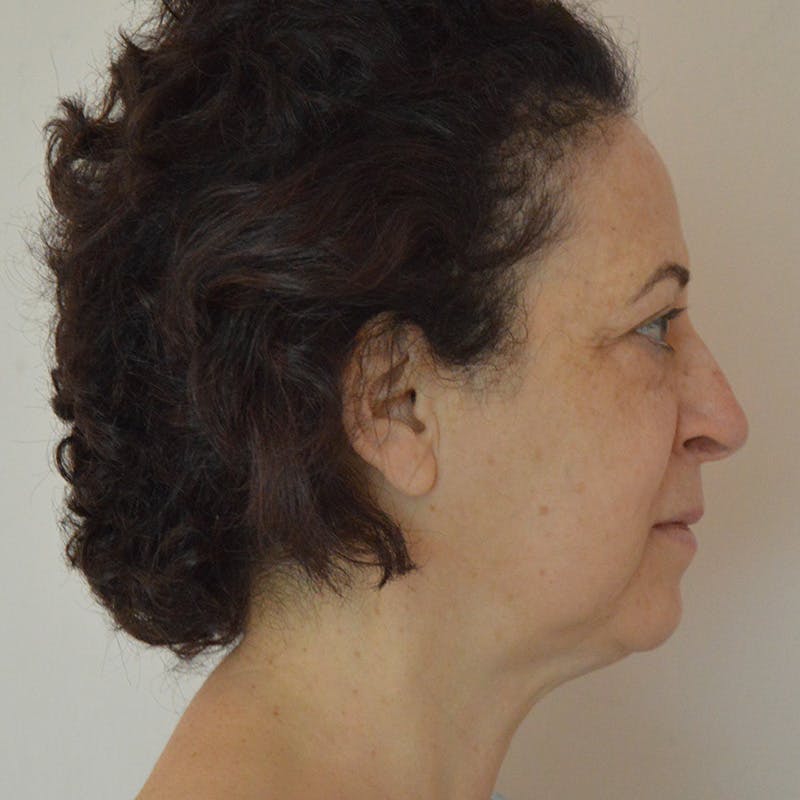 Facelift & Necklift Before & After Gallery - Patient 217555 - Image 5