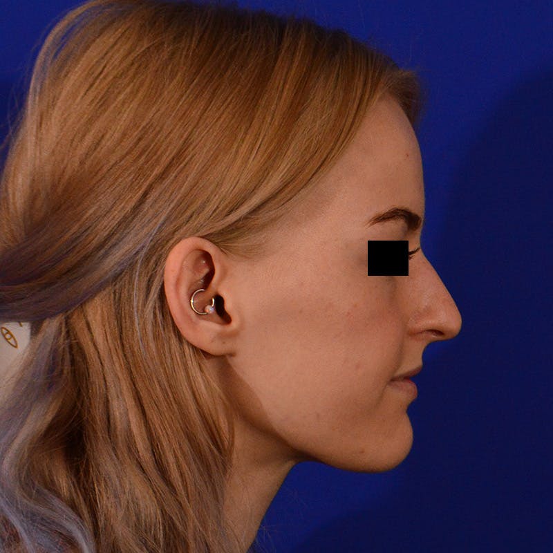 Female Rhinoplasty Before & After Gallery - Patient 124593 - Image 7