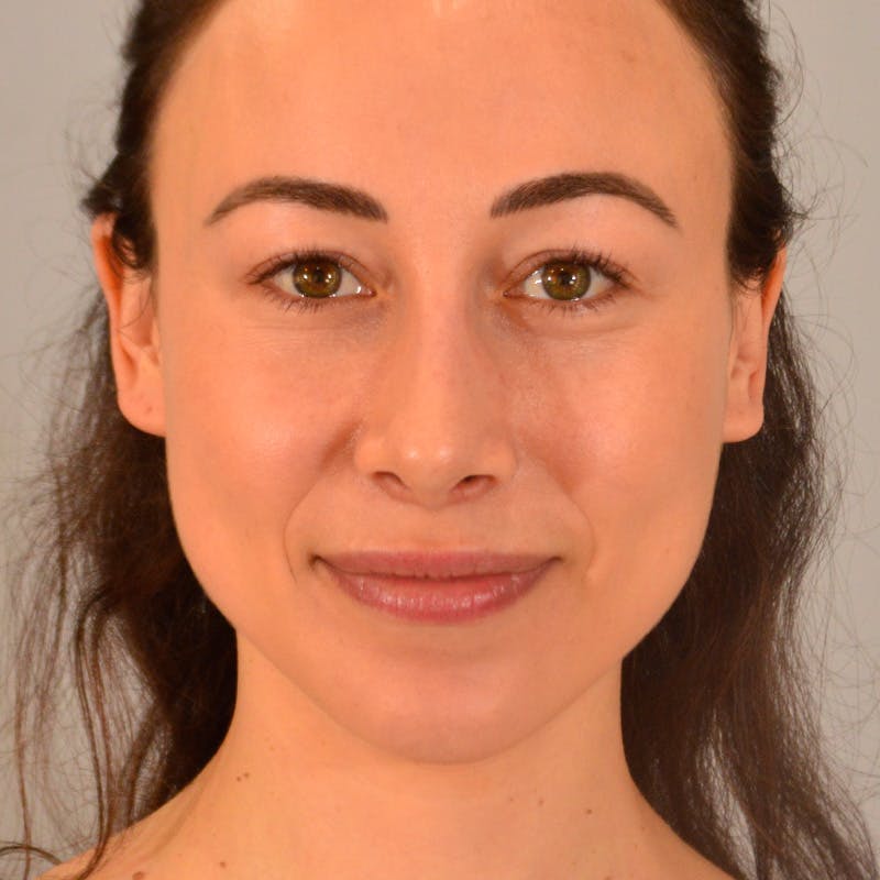 Small Changes Before & After Gallery - Patient 213801 - Image 2