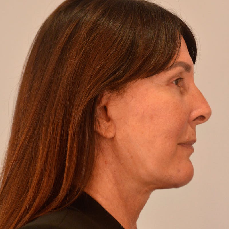 Facelift & Necklift Before & After Gallery - Patient 246000 - Image 6