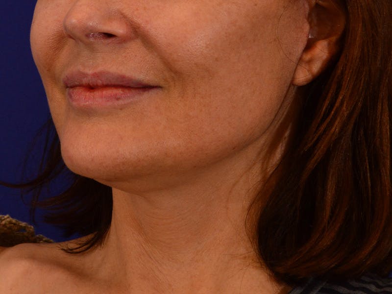 Facelift & Necklift Before & After Gallery - Patient 364835 - Image 8