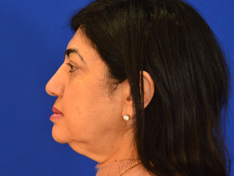 Buccal Fat Removal Before & After Gallery - Patient 351983 - Image 9