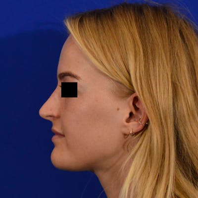 Female Rhinoplasty Before & After Gallery - Patient 124593 - Image 2