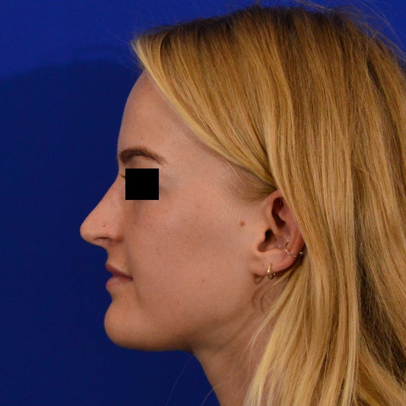 Female Rhinoplasty Before & After Gallery - Patient 124593 - Image 2