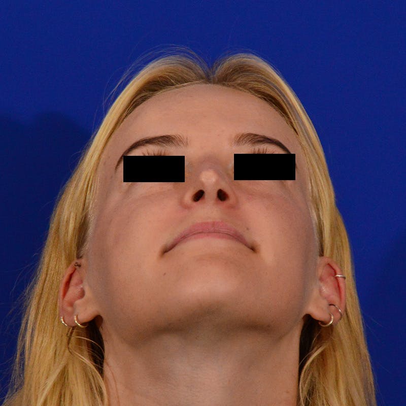 Female Rhinoplasty Before & After Gallery - Patient 124593 - Image 12