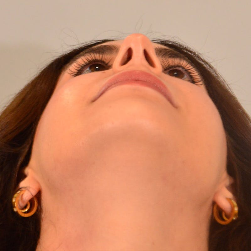 Dorsal Hump Before & After Gallery - Patient 275379 - Image 12