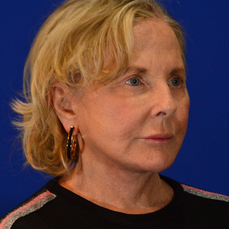 Co2 Laser Resurfacing Before & After Gallery - Patient 940417 - Image 4